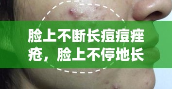 脸上不断长痘痘痤疮，脸上不停地长痤疮 